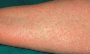 Аллергия на мандарины: симптомы и лечение